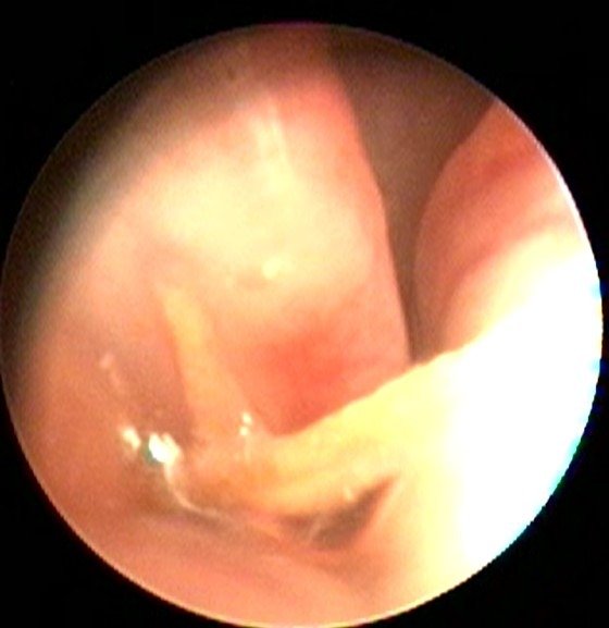 Un forasacco individuato con l'endoscopio