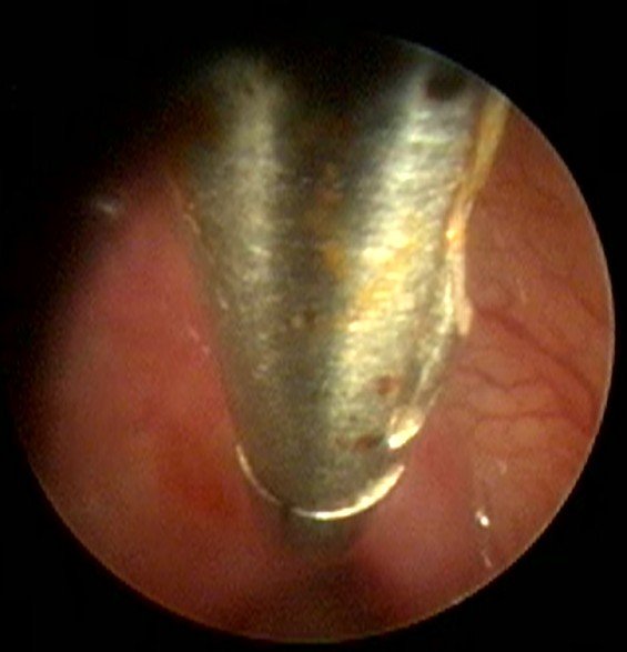 Strumento endoscopico al lavoro sulla mucosa