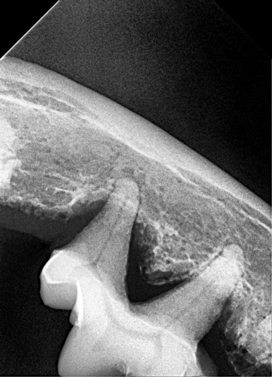 Radiografia dentale endorale: dente ferino con le radici che affondano nell'osso